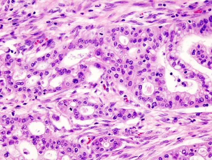 Liverpool Brings Hope for Pancreatic Cancer Future